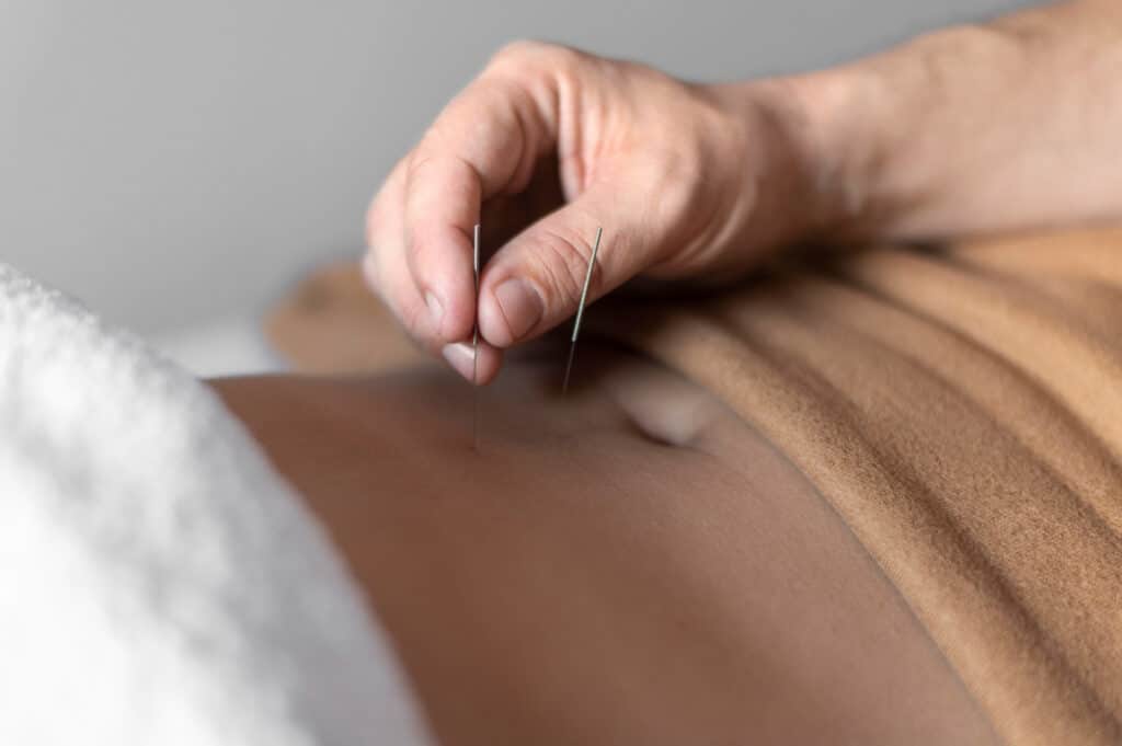 Acupuncture for intestine