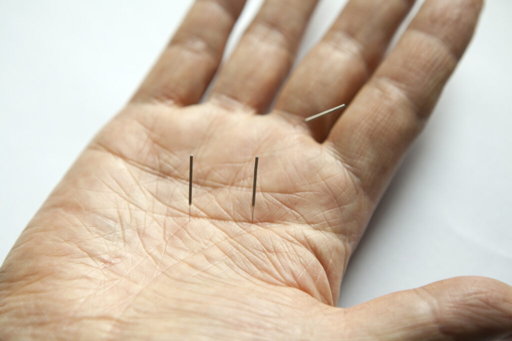 Acupuncture for nerve damage